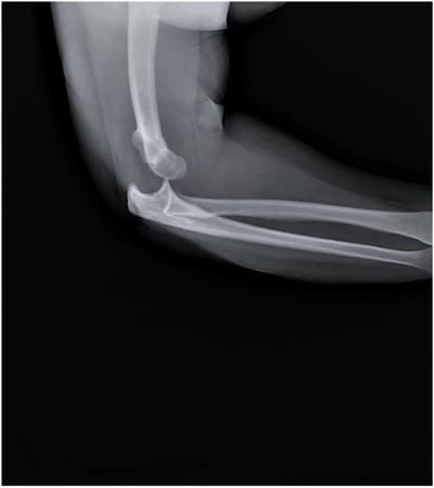 Broken bone