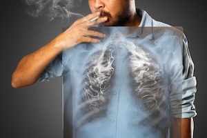 Lungs X-Ray of a smoking man