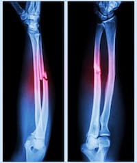 X-Ray